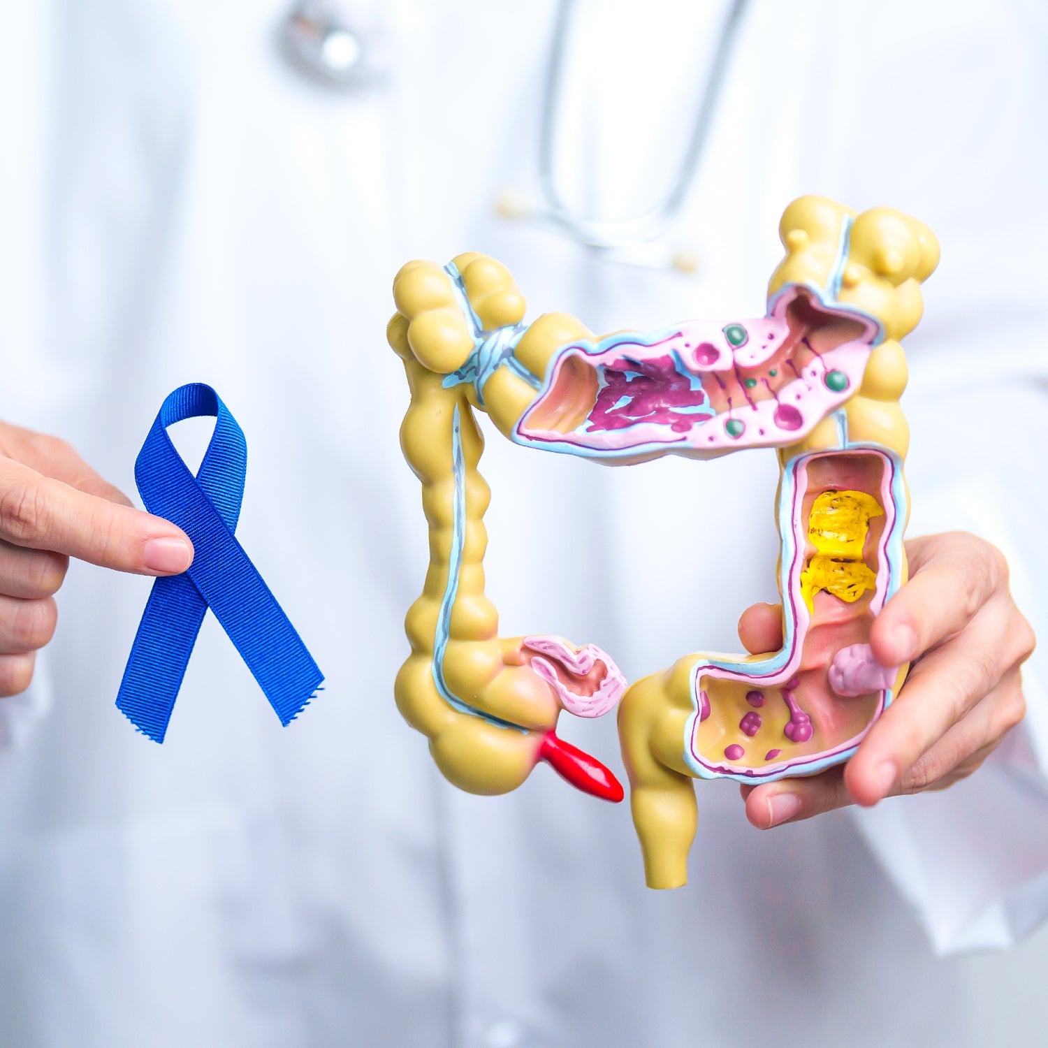 Microbiota y cáncer de colon ¿qué tiene para decir tu intestino?